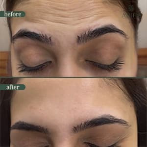 Botox before and after result 1