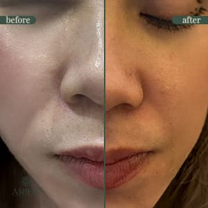Botox before and after result 2