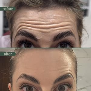 Botox before and after result 3