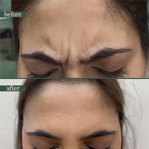 Botox before and after result 4